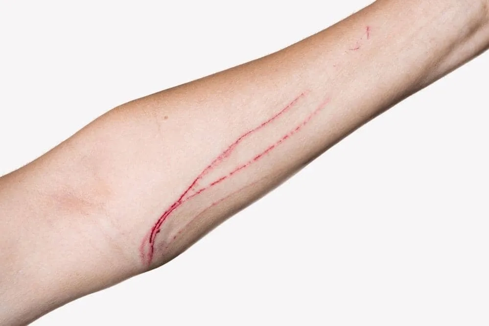 what to do if cat scratches you